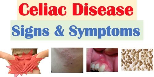 Celiac Deaase