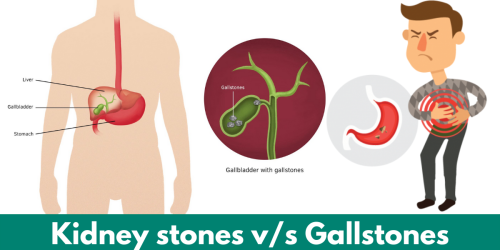 Kidney-stones-vs-Gallstones
