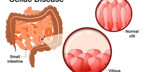 celiac-disease-gluten